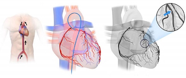 آنژیوگرافی قلب 
