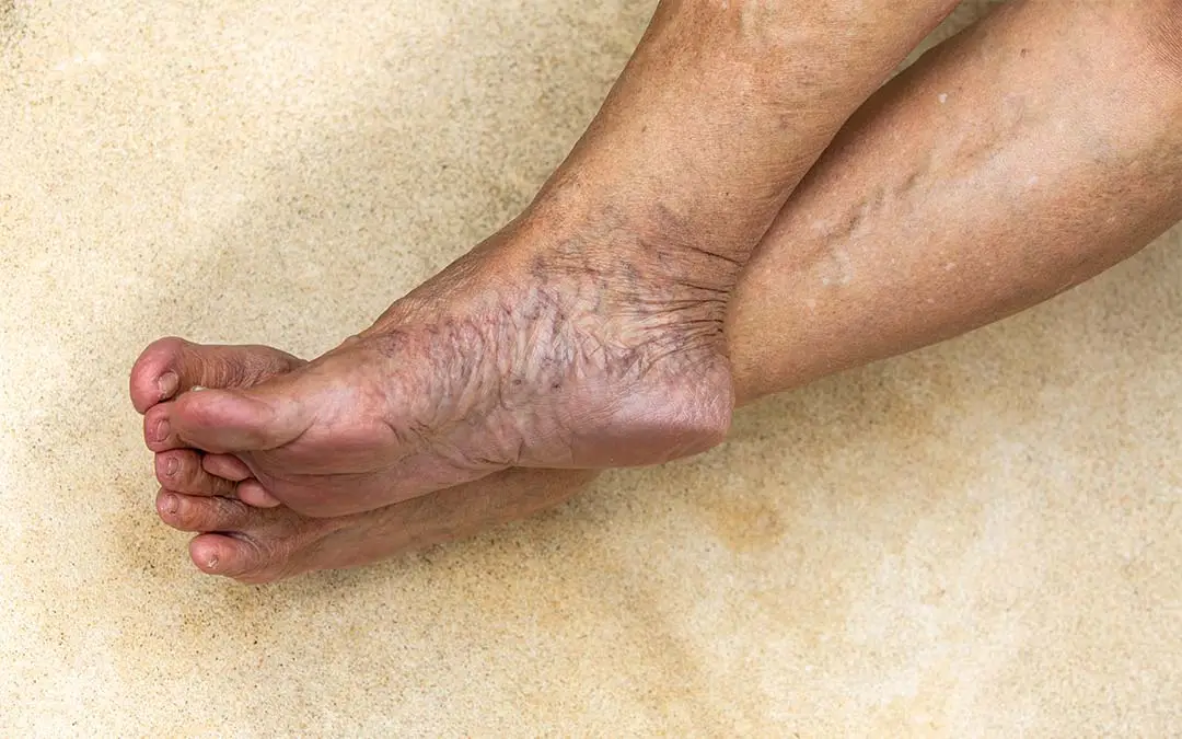 Varicose-veins-ankle