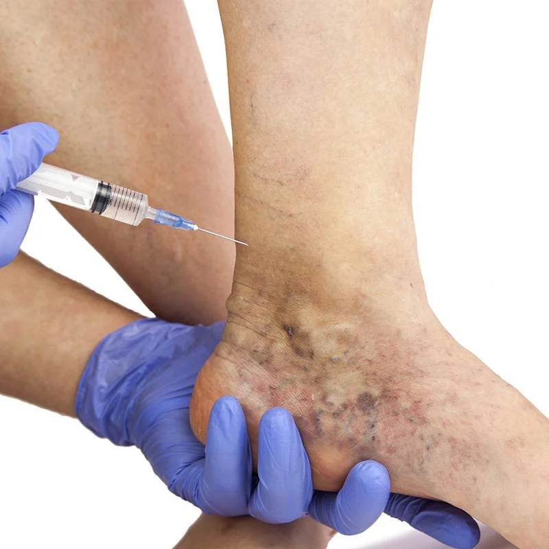Sclerotherapy-leg-varicose-veins
