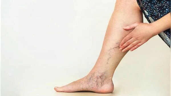 Varicose-leg-ulcer-treatment