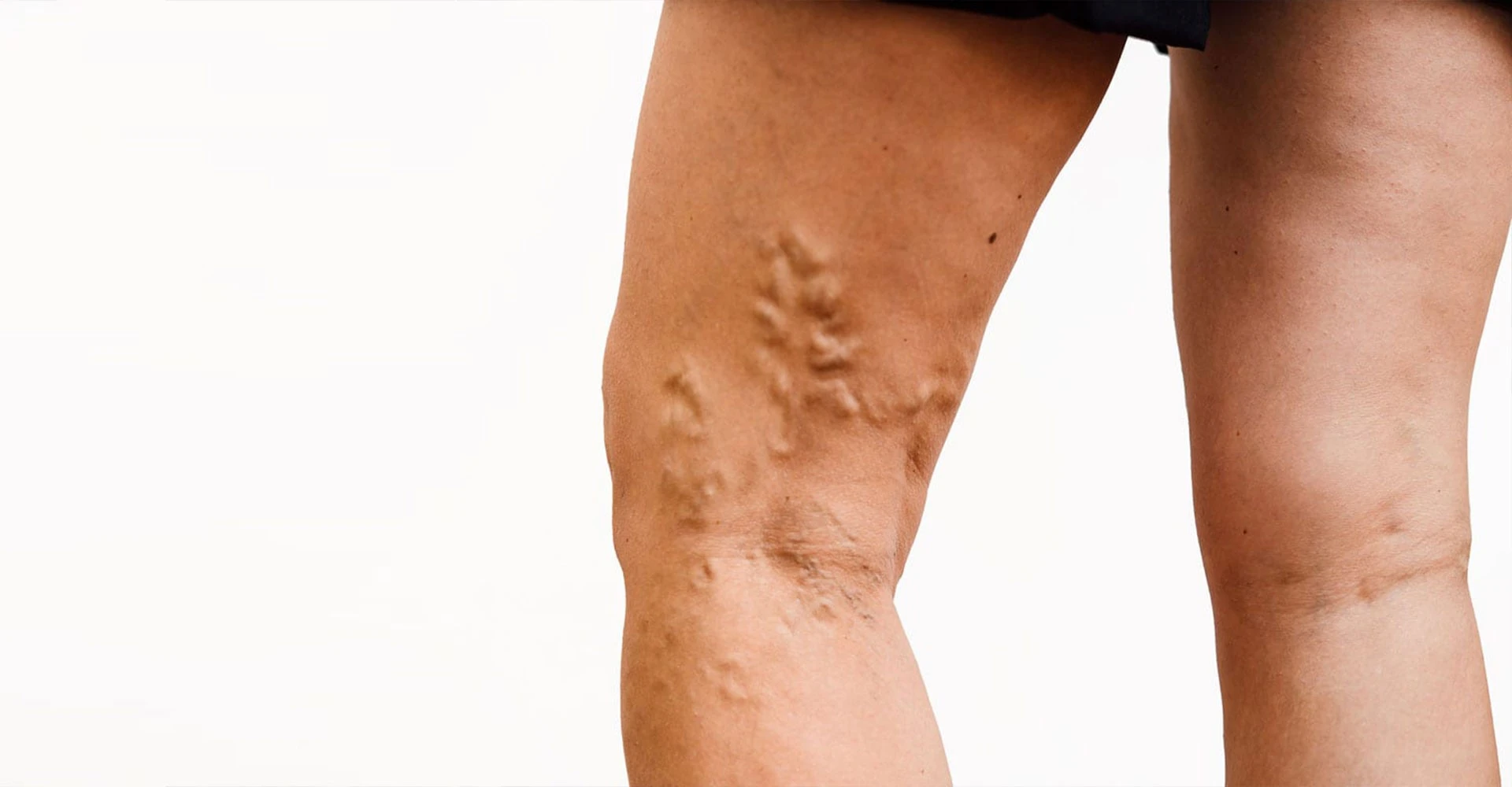 Varicose-veins-behind-knee