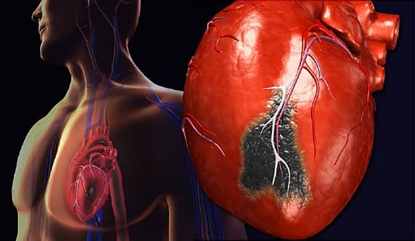 بهترین درمان سکته قلبی 